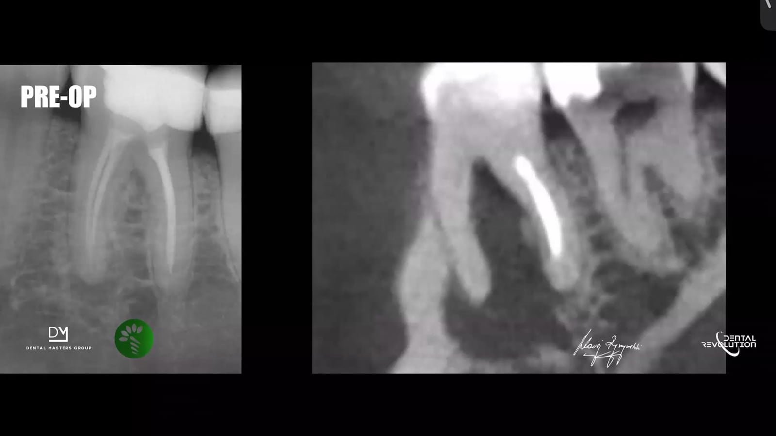Fragment webinaru ABC Obturacji: RTG przed leczeniem i CBCT