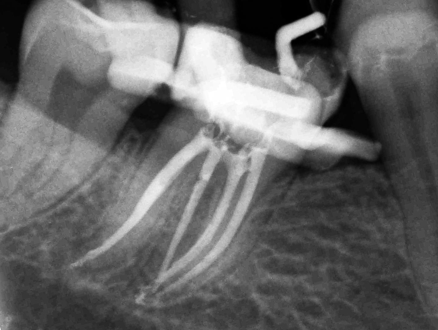 Przypadek 3 · Radix Entomolaris · 3 z 3