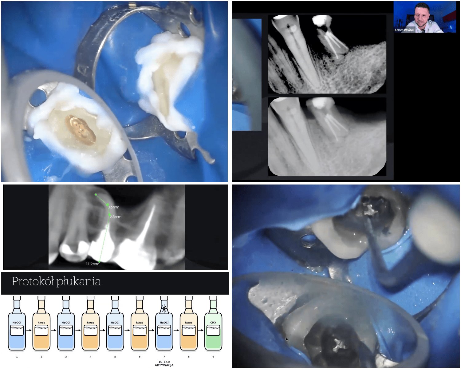 Kadry z webinaru: reendo pod mikroskopem, RTG, CBCT i protokół płukania