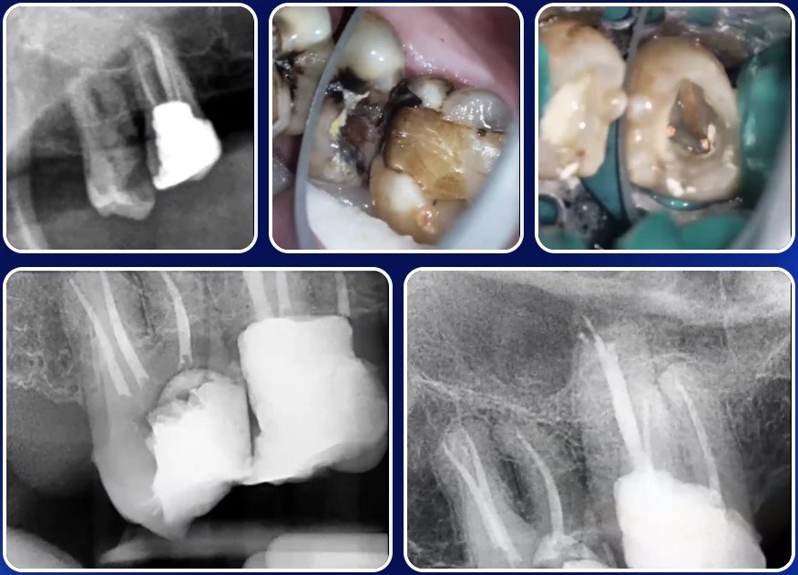Fragment webinaru: przypadki kliniczne, reendo czy ekstrakcja