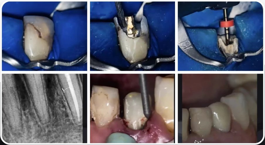 Fragment webinaru: przypadek kliniczny, usunięcie metalowego wkładu