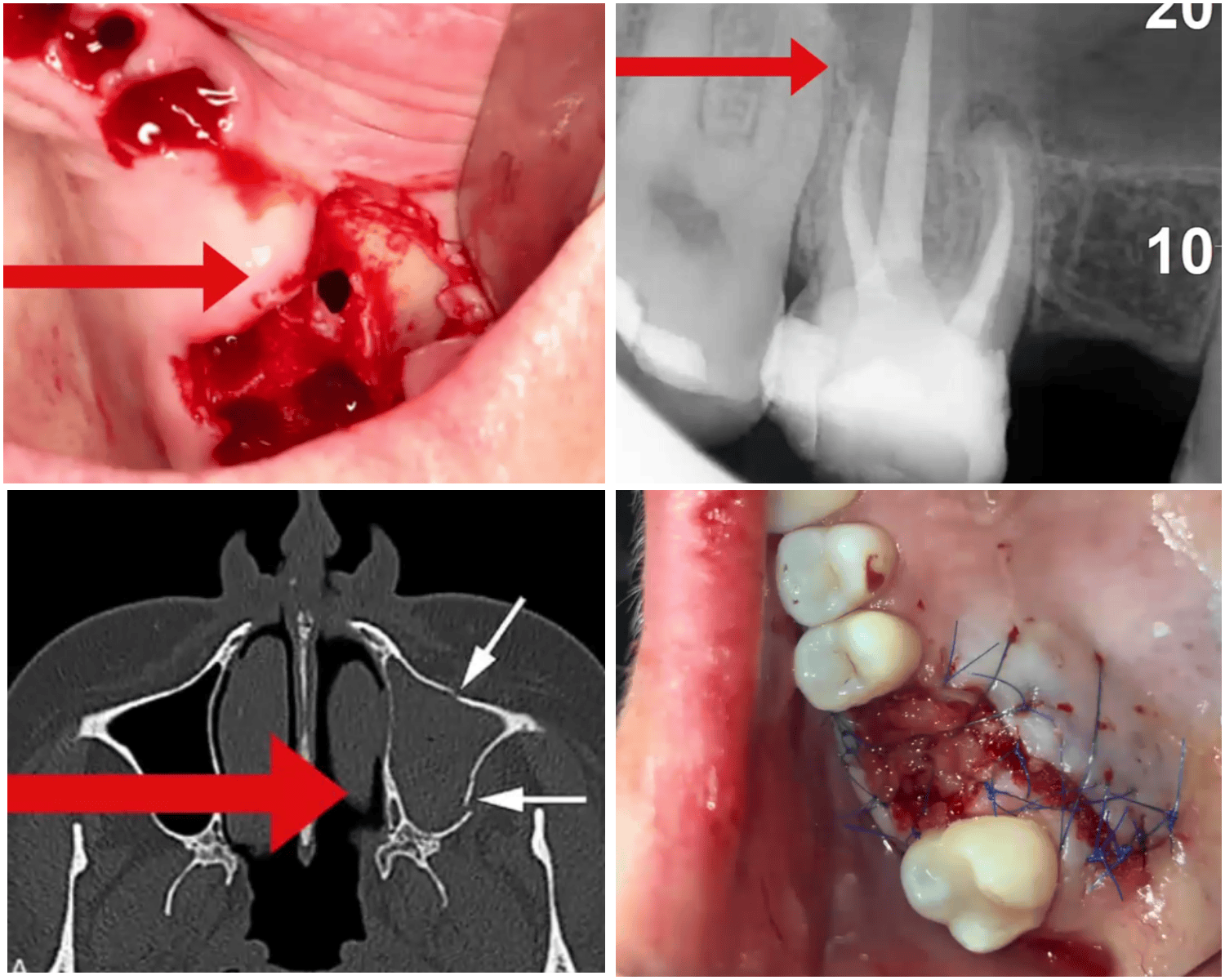 Przypadki PUZ: zabieg, RTG, CBCT, szycie