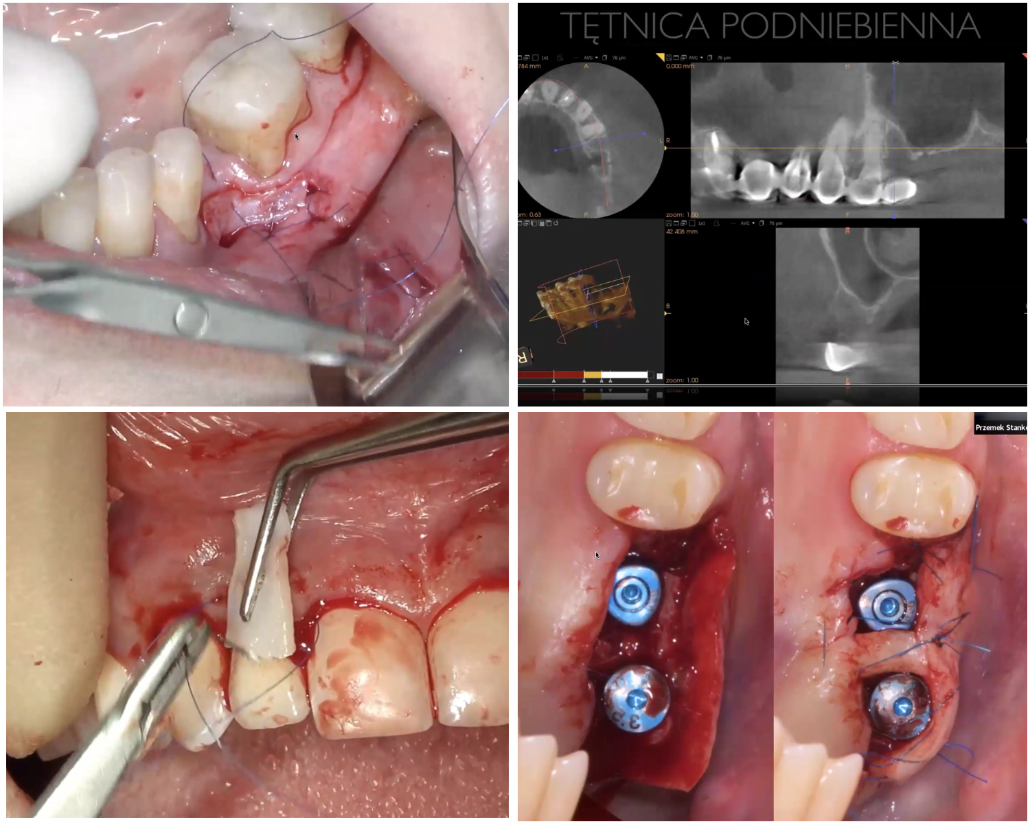 Kadry z lekcji, FGG, anatomia podniebienia, implanty