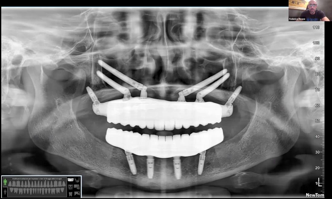 Implanty zygomatyczne i pterygoidalne na zdjęciu pantomograficznym