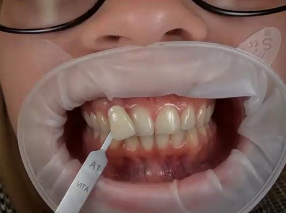 Praca tech. dent. Joanny Łupińskiej: dobór koloru ze skalą Vita